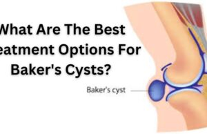 What Are The Best Treatment Options For Baker’s Cysts? bakers cyst