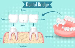 Benefits of Dental Bridges: Restore Your Smile & Confidence DEntal Bridges