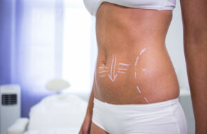 Benefits of Choosing Tummy tuck dubai After Pregnancy