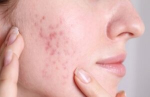 Clear Complexion Makeover Acne scar in Islamabad
