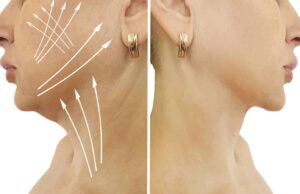 Can Double Chin Removal Transform Your Chin and Neck Effortlessly Now Double Chin Removal