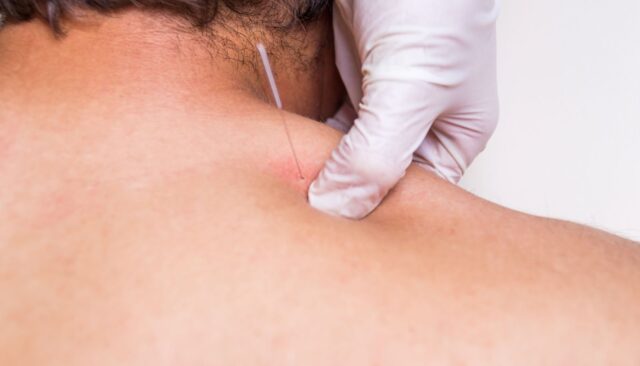 Dry Needling Therapy