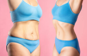 Liposuction for Stubborn Fat: Target Areas and Technique Insights Liposuction in Riyadh