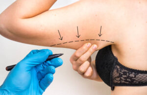 Liposuction Breakthroughs: Precision Sculpting for a Balanced, Youthful Form Liposuction in Riyadh