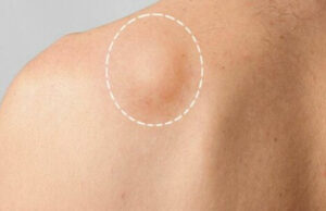 Reliable Lipoma treatment in Islamabad – Pain-Free Solution lipoma treatment in Islamabad