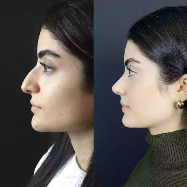 Nose Surgery and Nose Fillers Clinic in Islamabad