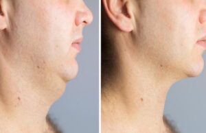 Perfect Your Profile: Chin Lipo Treatment in Islamabad chin lipo treatment