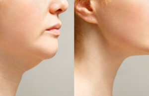 Top Clinic for Double Chin Liposuction in Islamabad double chin liposuction