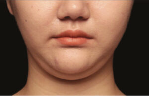 Finding Reliable Double Chin Liposuction in Islamabad double chin liposuction