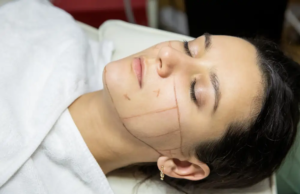 Can HIFU Treatment Boost Skin Radiance While Smoothing Wrinkles HIFU