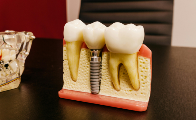 tooth implant new orleans
