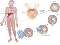 How Patients in Farmington Can Cope with Recurrent Prostate Cancer