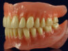 What Are BPS Dentures? A Complete Guide to Biofunctional Prosthetic System bps denture