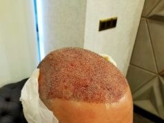 Can Hair Transplant For Men Improve Crown Area Baldness? Hair Transplant in Dubai