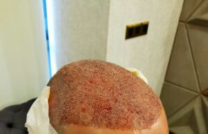 Can Hair Transplant For Men Improve Crown Area Baldness? Hair Transplant in Dubai