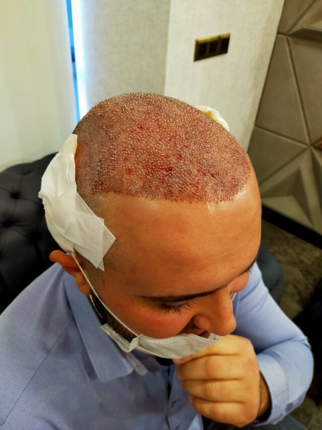 Hair Transplant in Dubai
