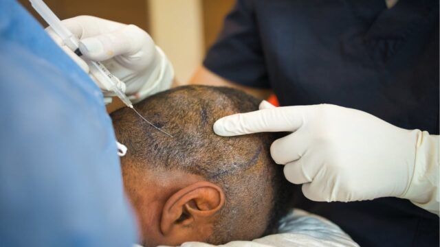 Hair Transplant in Dubai
