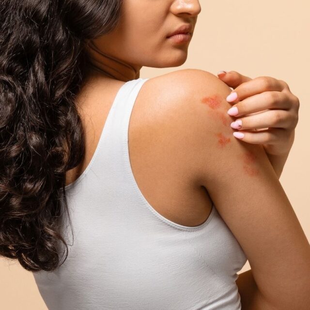 Keloid Treatment in Dubai