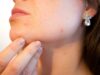 Does Pimples Treatment Help Regulate Skin Inflammation Levels? Pimples Treatment in Dubai