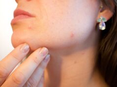 Does Pimples Treatment Help Regulate Skin Inflammation Levels? Pimples Treatment in Dubai