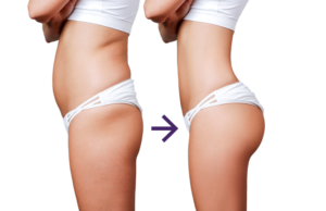 Fat Transfer Surgery Recovery Timeline: What to Expect