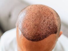 Hair Transplant in Dubai: How to Boost Hair Growth After Surgery