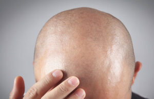 How Can Hair Transplant Enhance Hair Thickness? Hair Transplant in Dubai