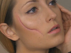 How Does Scar Removal Help Achieve Clear and Smooth Skin? Scar Removal in Dubai