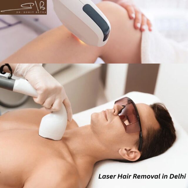Laser Hair Removal