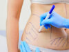 What You Should Know Before Getting Liposuction in Riyadh liposuction in riyadh