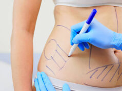 What You Should Know Before Getting Liposuction in Riyadh liposuction in riyadh