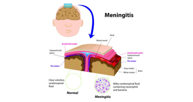 Meningitis