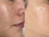PicoSure Laser Treatment for Brown Spots: Complete Guide PicoSure Laser Treatment for Brown Spots: Complete Guide