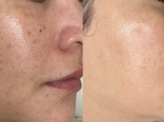 PicoSure Laser Treatment for Brown Spots: Complete Guide PicoSure Laser Treatment for Brown Spots: Complete Guide