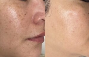 PicoSure Laser Treatment for Brown Spots: Complete Guide PicoSure Laser Treatment for Brown Spots: Complete Guide