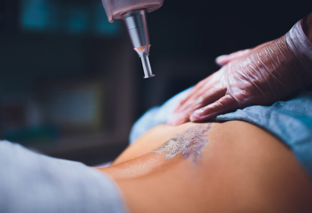Picosure Tattoo Removal for Dark Skin: What You Should Know