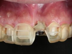 What Is a Surgical Drill Guide? A Complete Guide for Dental Implants surgical drill guide