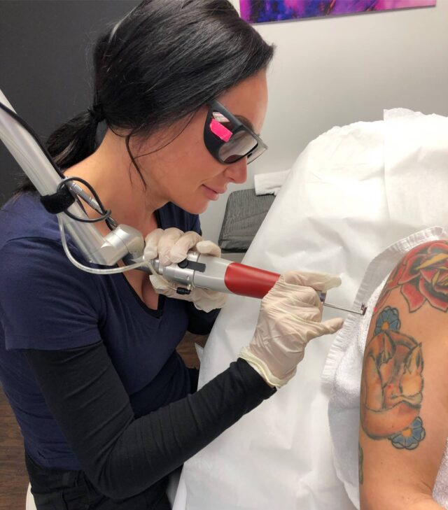 Laser Tattoo Removal Dubai