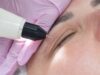What Skin Concerns Can Plasma Pen Treatment Treat? Plasma Pen Treatment in Dubai
