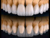 What Is a Zirconia Crown? A Complete Guide for Patients zirconia crown