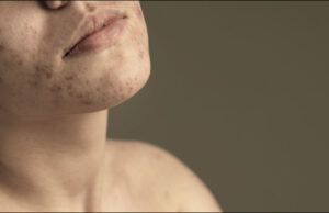 The 4 Pillars of Acne: What’s Actually Happening in Your Pores? Acne