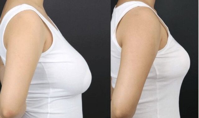 breast reduction