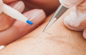 Is Electrolysis Laser Hair Removal Ideal for Effortless Hair-Free Grooming Daily Instantly