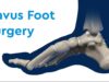 Specialist Surgery for Complex Foot Deformities Edinburgh Specialist Surgery for Complex Foot Deformities Edinburgh