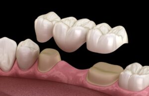 Dental Bridge Fell Out: What to Do Right Now dental bridge by pleasant dental