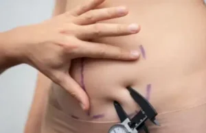 Gynecomastia Surgery Cost in Lahore: A Comprehensive Guide tummy tuck in lahore